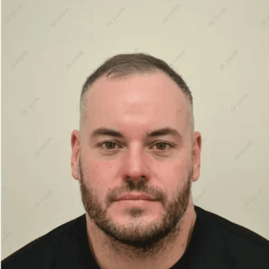 Hair Transplant - Before
