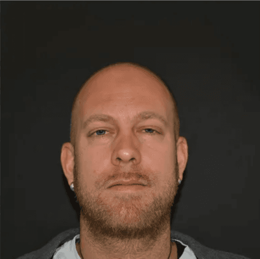 Hair Transplant - Before