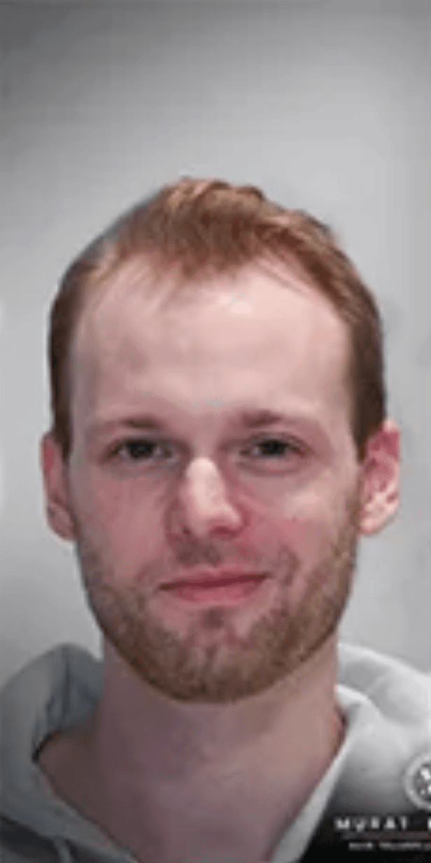 Hair Transplant - Before
