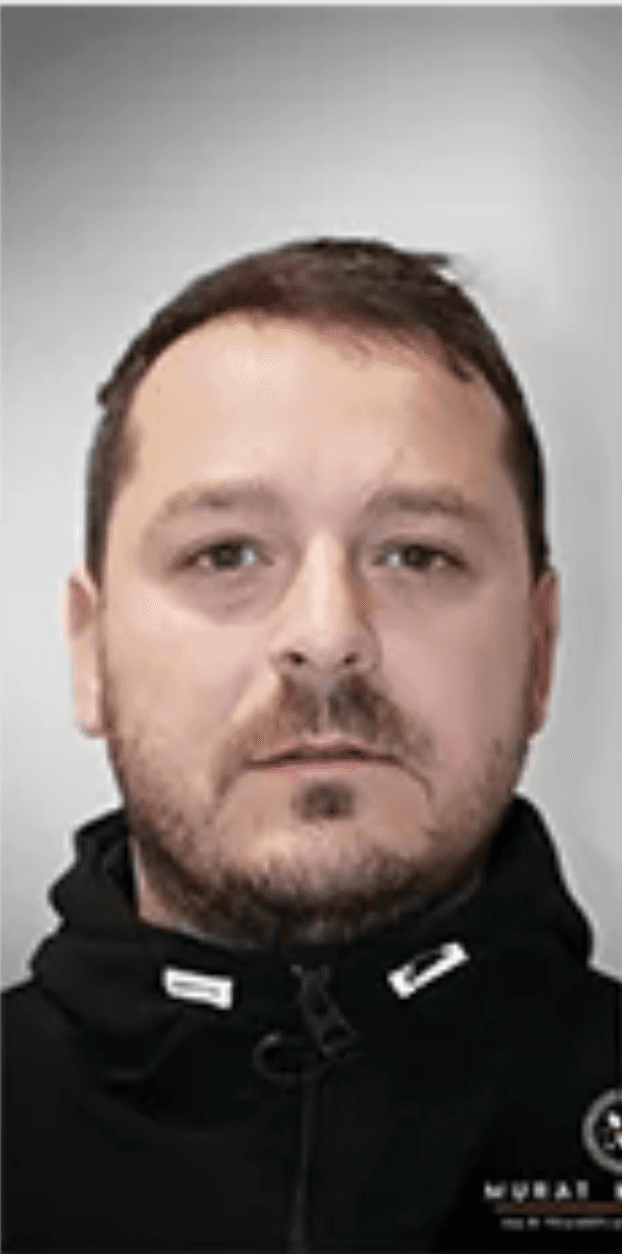 Hair Transplant - Before