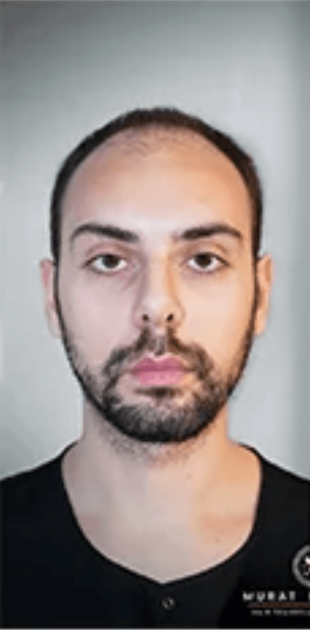 Hair Transplant - Before