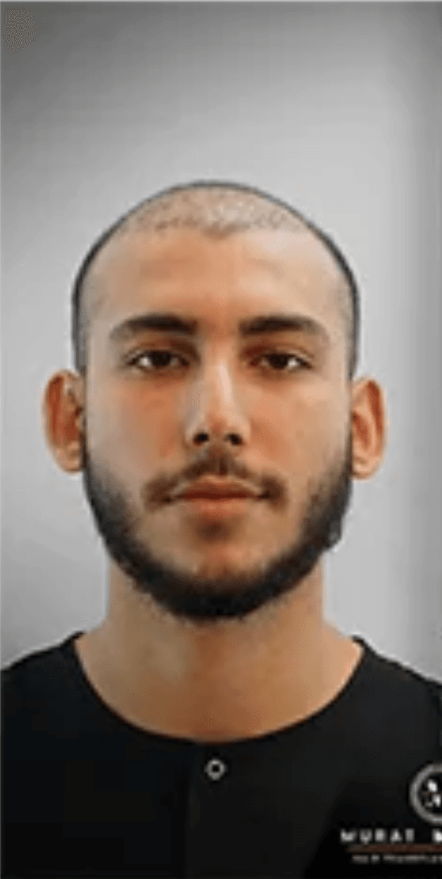 Hair Transplant - Before