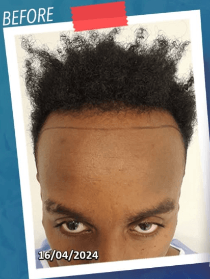 Hair Transplant - Before