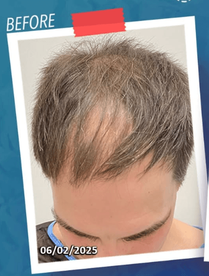 Hair Transplant - Before