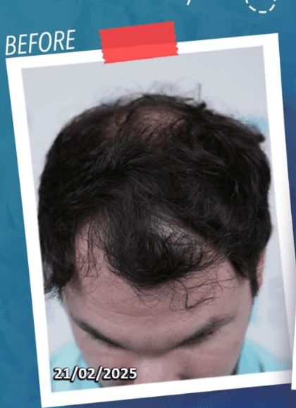 Hair Transplant - Before