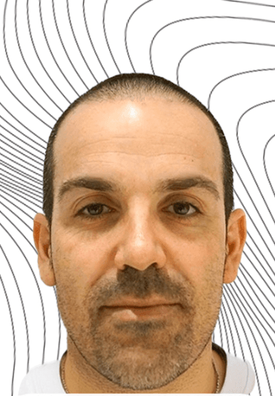 Hair Transplant - Before