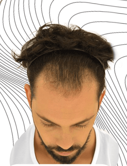 Hair Transplant - Before