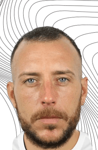 Hair Transplant - Before