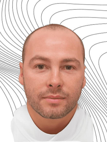 Hair Transplant - Before