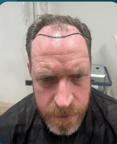 FUE Hair Transplant - Before