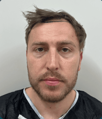 FUE Hair Transplant - Before