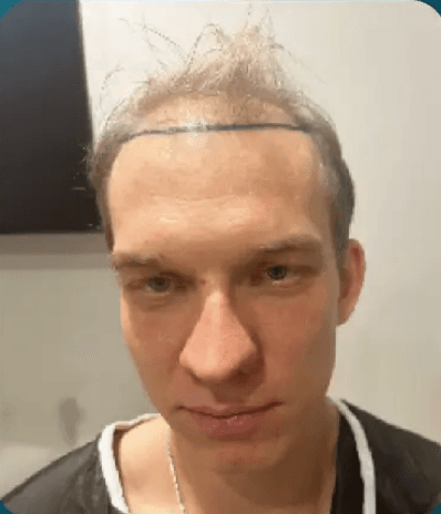 DHI Hair Transplant - Before