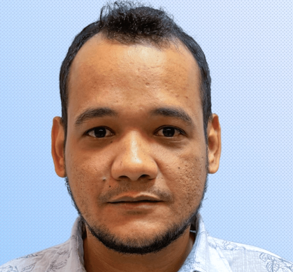 Hair Transplant - Before