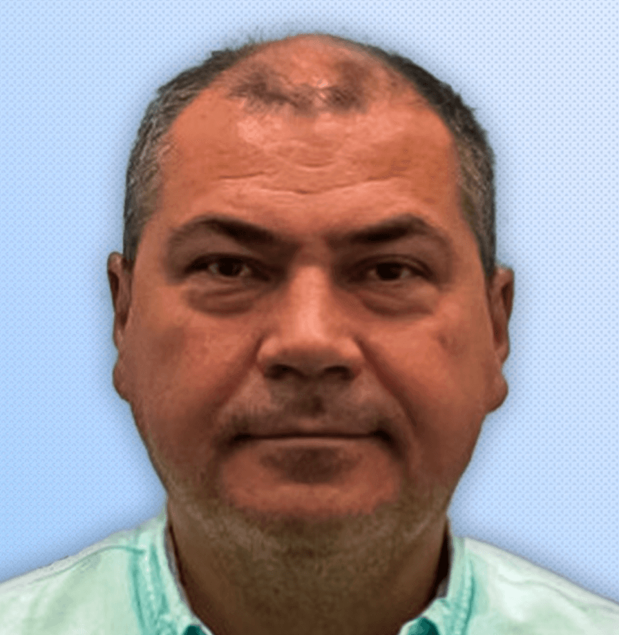 Hair Transplant - Before