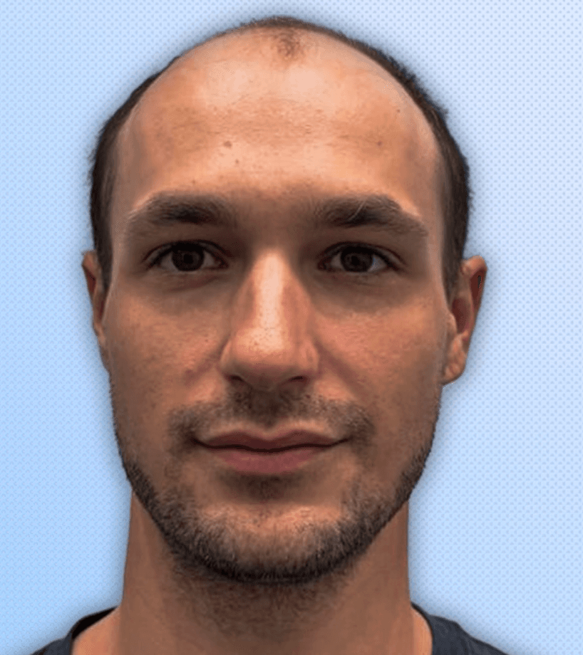 Hair Transplant - Before