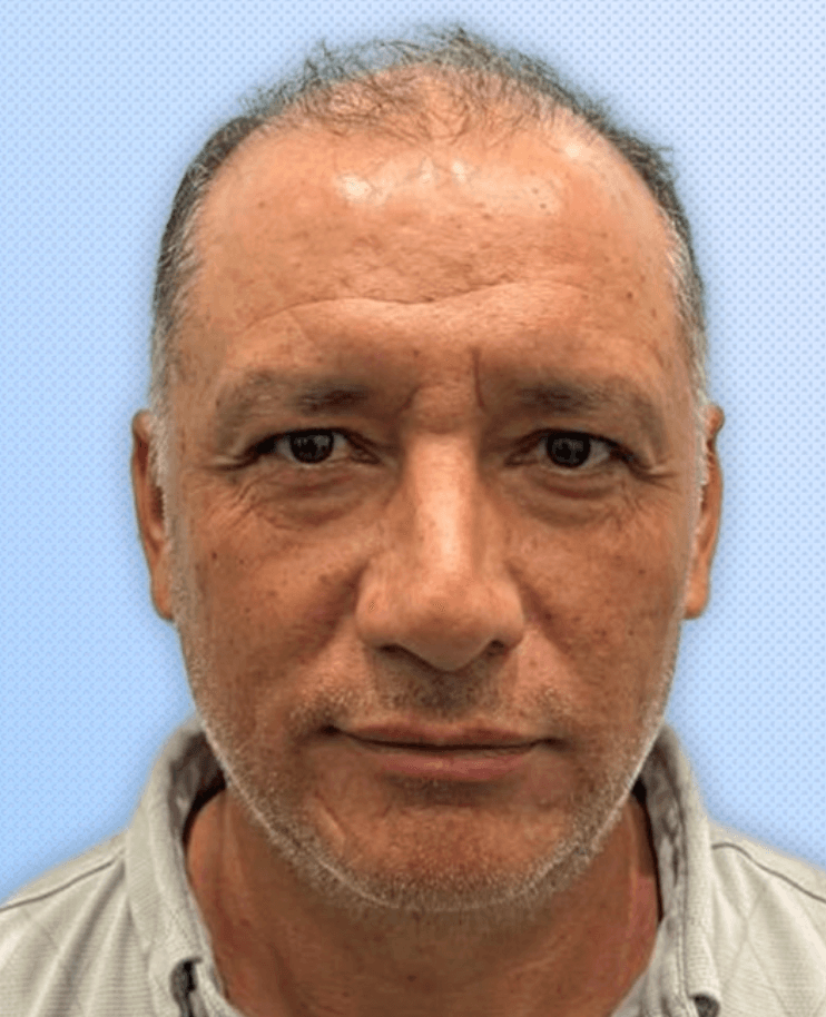 Hair Transplant - Before