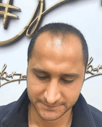 Hair Transplant - Before