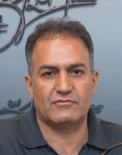Hair Transplant - Before