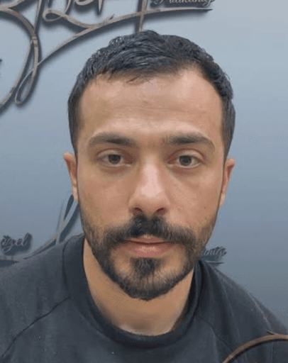 Hair Transplant - Before