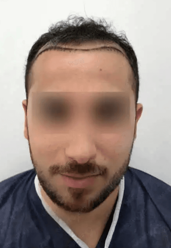 Hair Transplant - Before