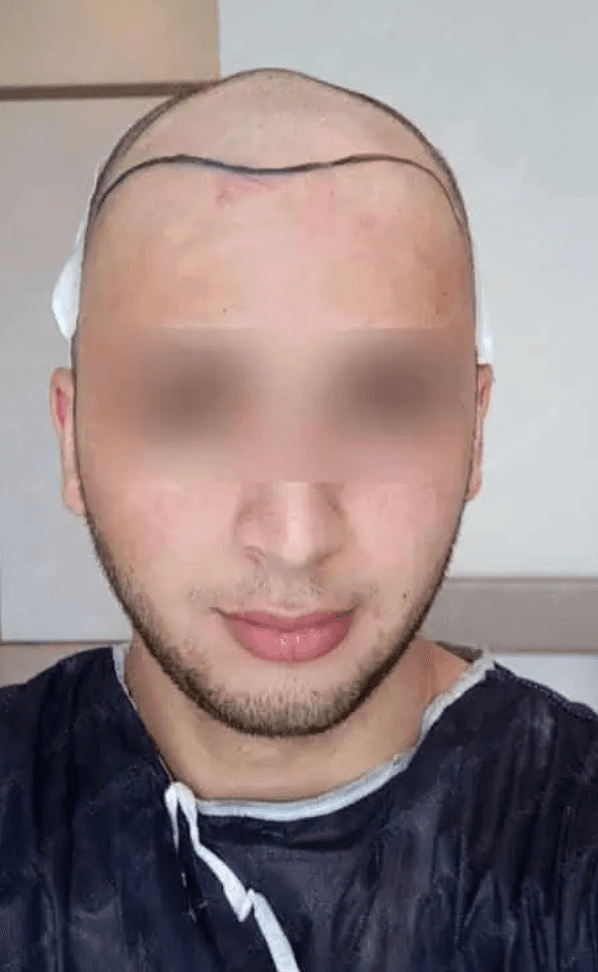 Hair Transplant - Before