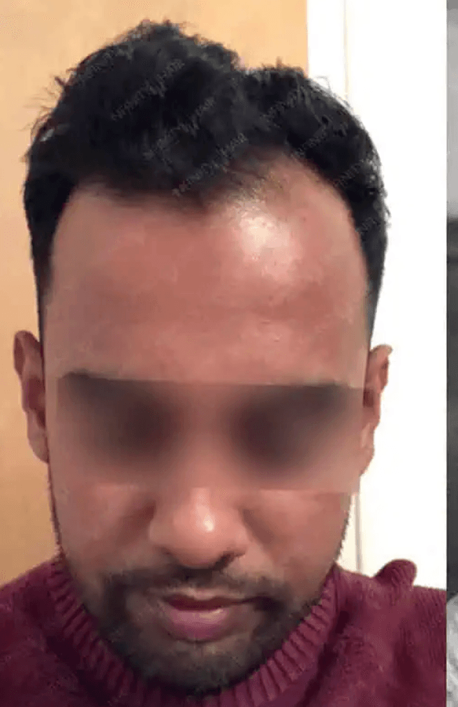 Hair Transplant - Before