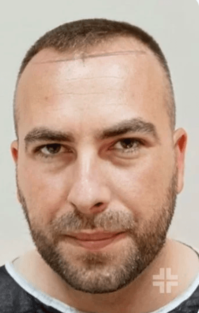 Dhi-Choi (pen) Technique Hair Transplant - Before