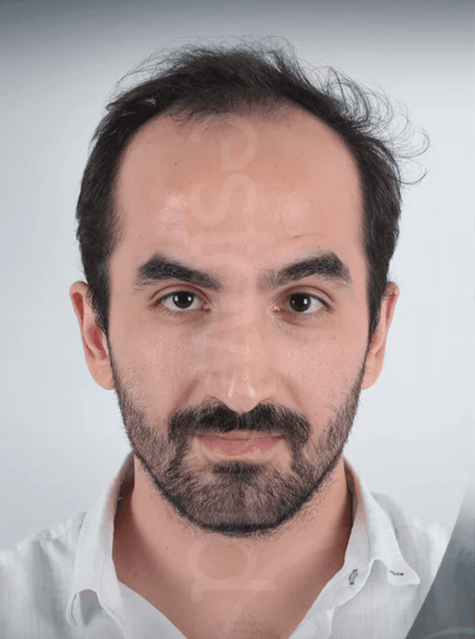 Hair Transplant - Before