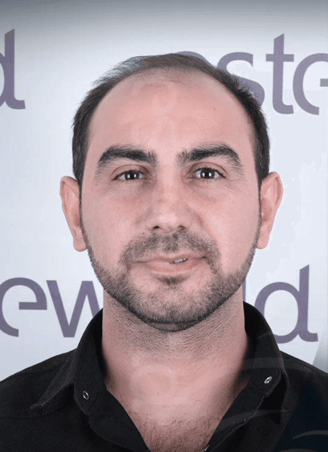 Hair Transplant - Before