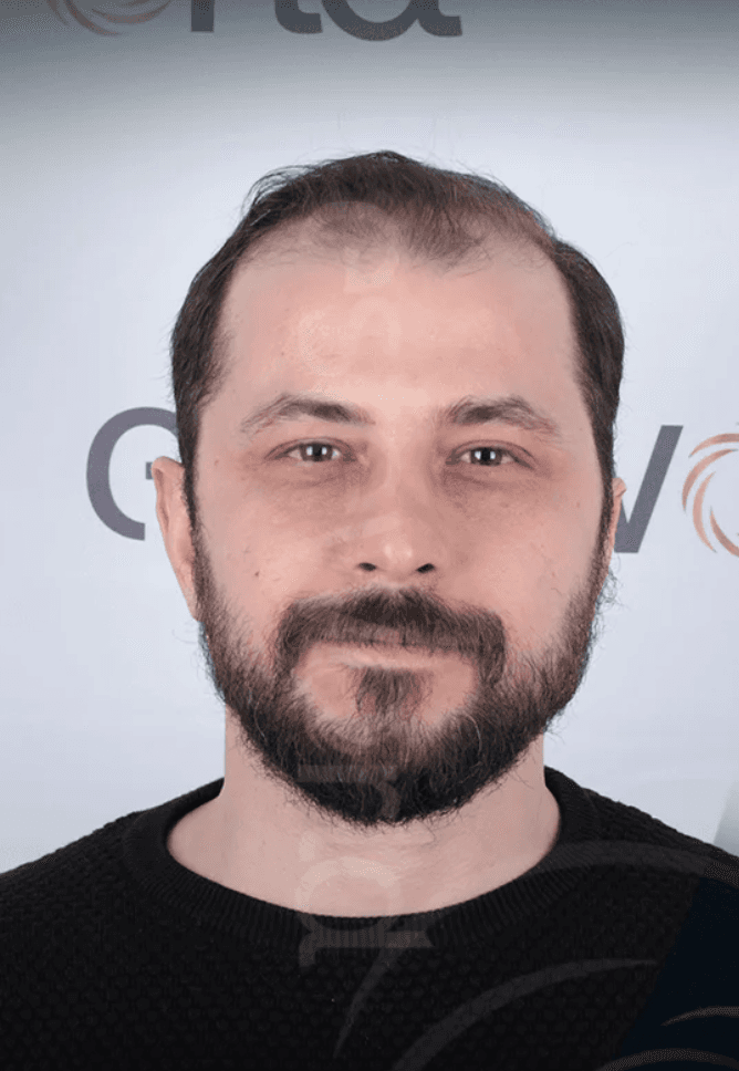 Hair Transplant - Before