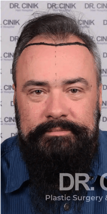 FUE Hair Transplant - Before