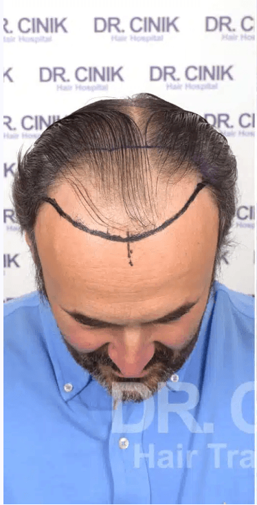 FUE Hair Transplant - Before