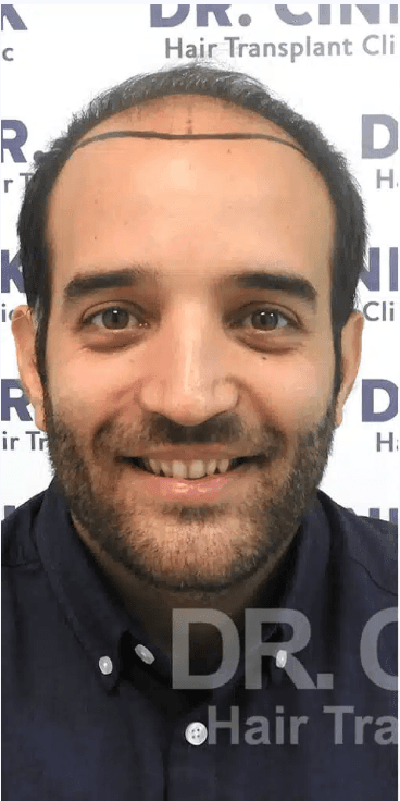 FUE Hair Transplant - Before